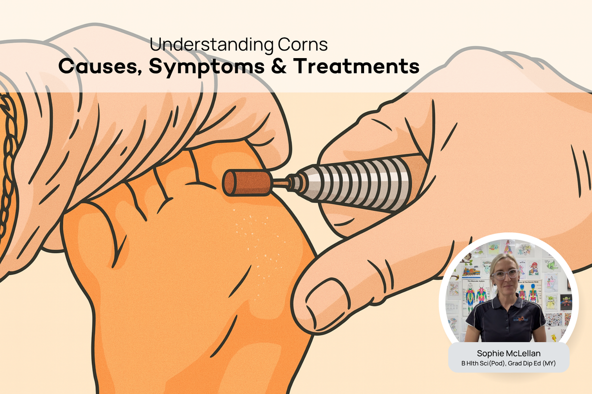 What Are Corns? Causes & Treatment | Podiatry Corner – Comfort Co Shoes ...