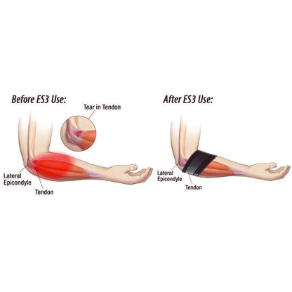 Elbow Compression Sleeve For Bursitis (ES3) - Black
